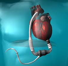 Left Ventricular Assist System Recalled Left Ventricular Assist System Recalled