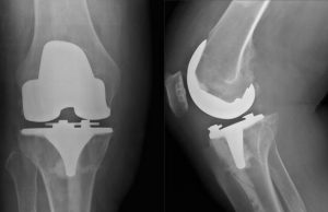 Zimmer Knee Implant Lawsuits