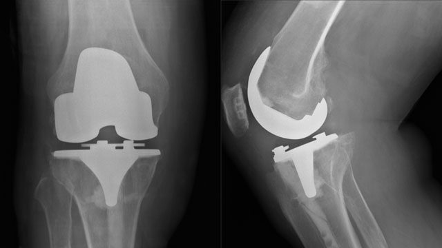 Zimmer Knee Implant Lawsuits
