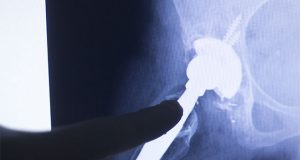 DePuy Pinnacle Hip Implant Health Risks