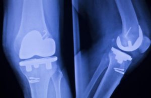 DePuy Attune Knee Replacement Risks