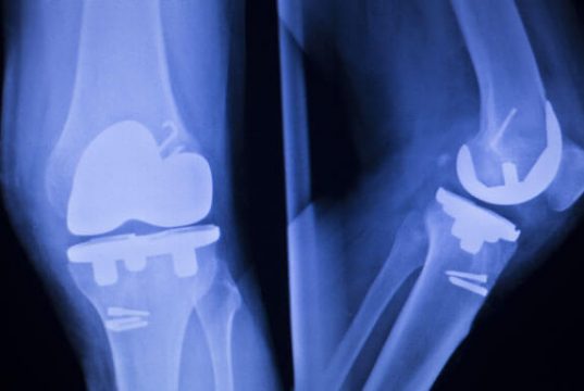 DePuy Attune Knee Replacement Risks